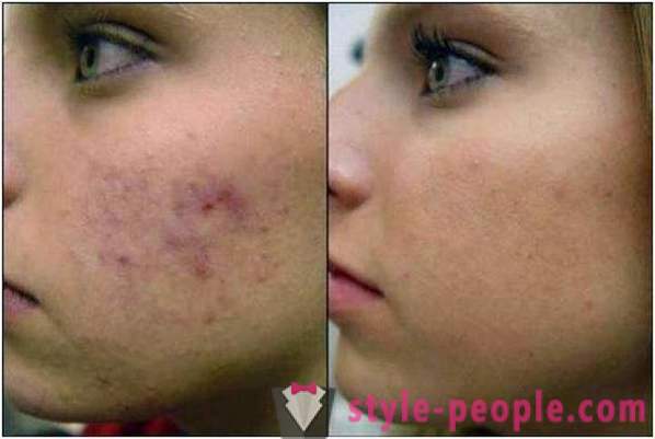 Atselaiinihappo kuorii: arvosteluja kosmetologit, valokuvia ennen ja jälkeen