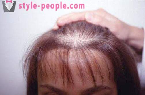 Darsonval hiukset. Sovellus darsonvalya hoitoon ja ehkäisyyn hiustenlähtöä