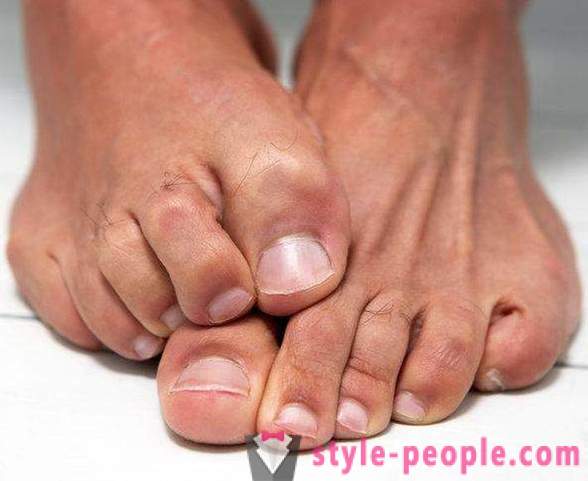 Kuiva iho jalat: Syyt